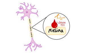 Lee más sobre el artículo Cada vez más cerca de frenar la esclerosis múltiple